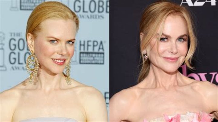 Nicole Kidman Facelift | Plastic Surgery Before And After